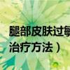 腿部皮肤过敏怎么办（给大家介绍一些基本的治疗方法）